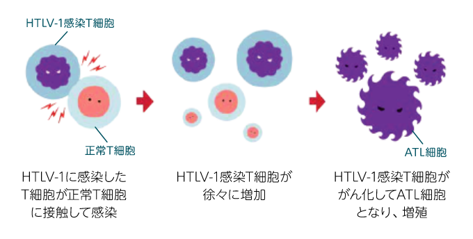 成人T細胞白血病・リンパ腫（ATL）とは