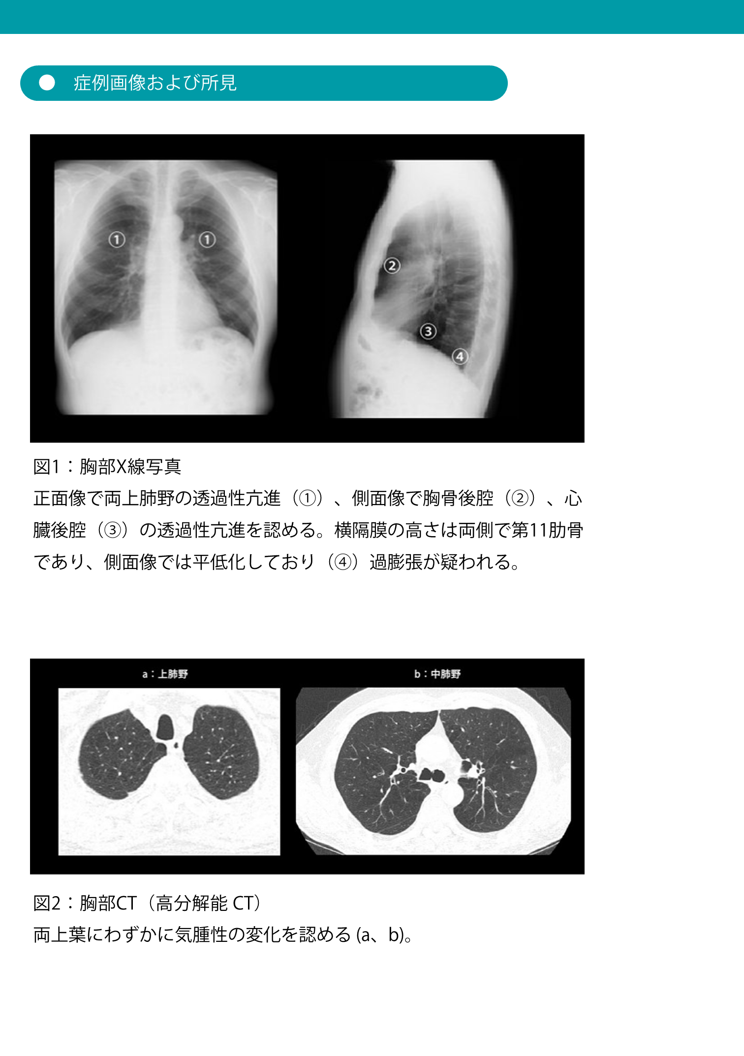 疾患別 2013〜2024年の概要 – 小児・成人の侵襲性肺炎球菌感染症の疫学情報