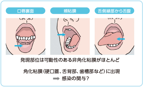 美品　口腔粘膜疾患 歯科クリニック　oral 臨床で遭遇する口腔粘膜疾患に強くなる本 | 岩渕 博史, 伊東